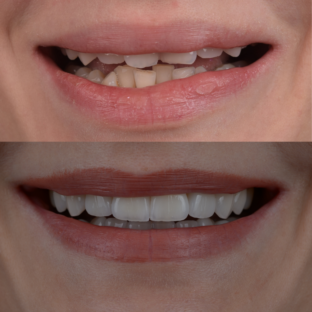Smile makeover. Fatete dentare inainte si dupa la clinica Dr. Baldea in Timisoara.