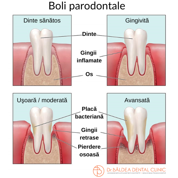 Progresul bolilor parodontale. Gingivita, retragere gingivala, parodontita si parodontoza.