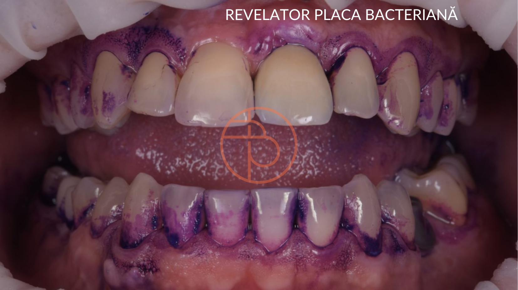 Placa bacteriana inainte de detartraj si igienizarea profesionala, la dr. Baldea Dental Clinic Timisoara.