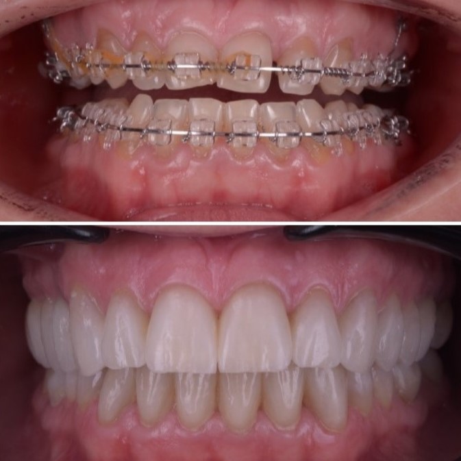 Ortodont Timisoara. Aparat dentar rezultate inainte si dupa. 