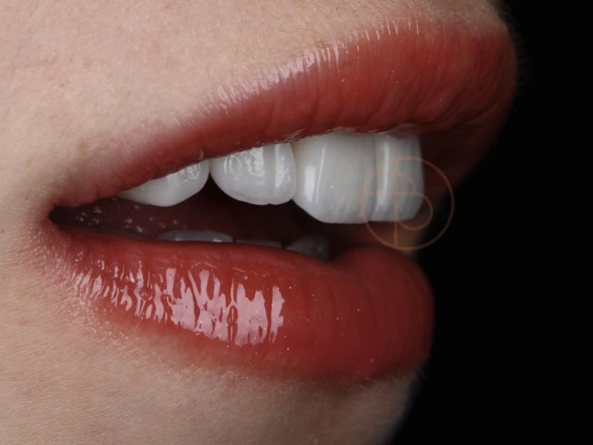 Transformarea zambetului cu ajutorul implanturilor dentare de cea mai buna calitate, la clinica stomatologica dr. Baldea in Timisoara.