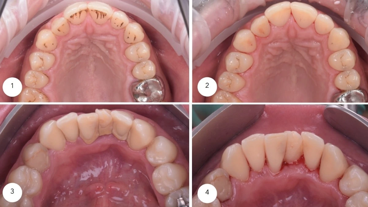 Detartraj si airflow la clinica dentara dr. Baldea din Timisoara. Eliminare tartru, inainte si dupa.