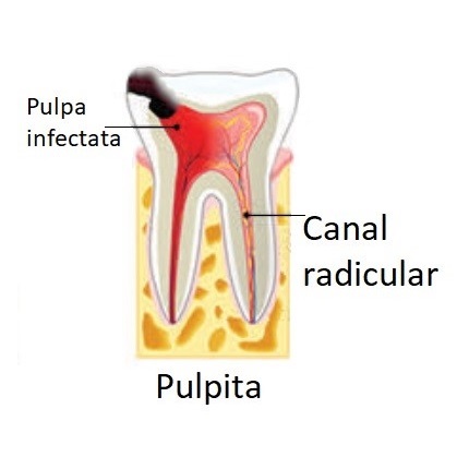 Endodont in timisoara. Tratament de canal sau obturatie de canal in caz de pulpita.