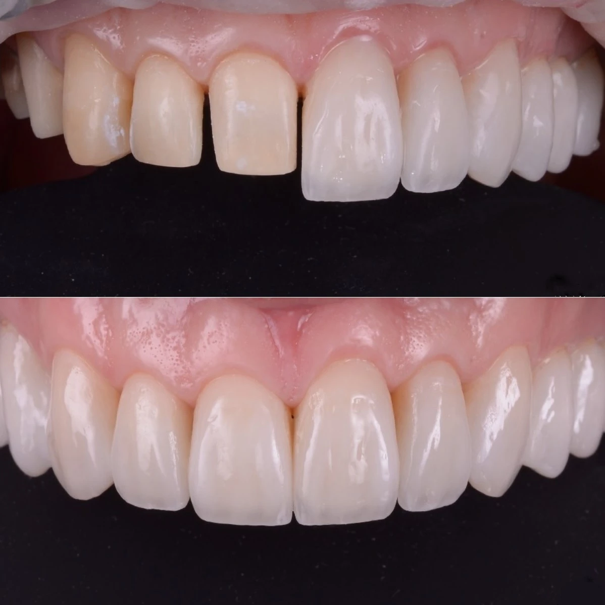 Fatete dentare din ceramica cu prepare (cu slefuire). Inainte si dupa, la Clinica dentara Dr. Baldea Timisoara.