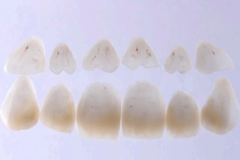 Fatete dentare din ceramica. Pentru exteriorul si interiorul dintelui, inainte de aplicare la Clinica Stomatologica Dr. Baldea Timisoara.