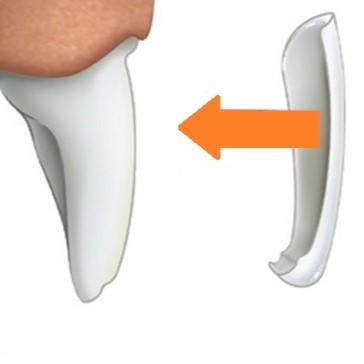 Cum arata o fateta dentara si cum se aplica pe dinte. Descriere grafica.