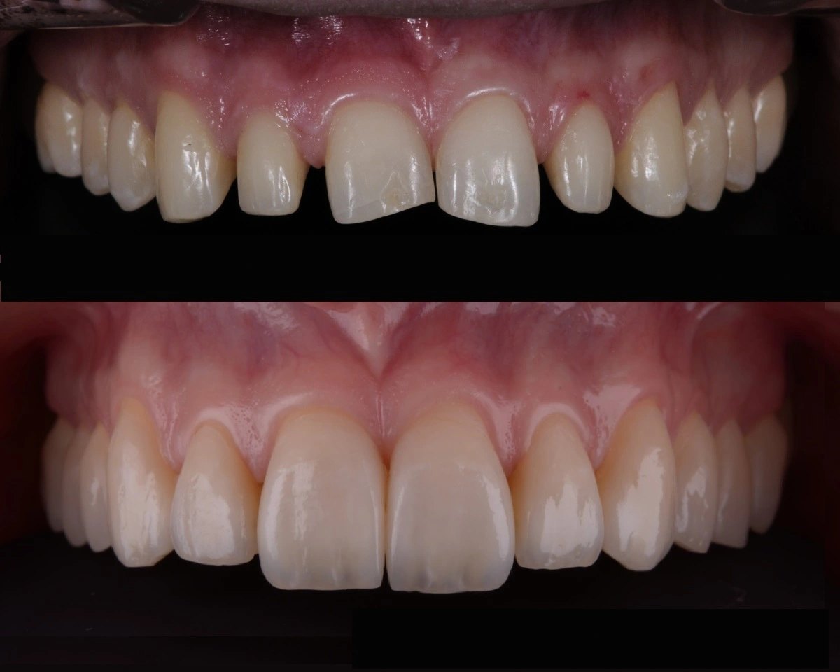 Fatete dentare fara slefuire, fara preparare. Fatete aplicate direct pe dinti la Clinica Dentara Dr. Baldea Timisoara. Inainte si dupa aplicare.