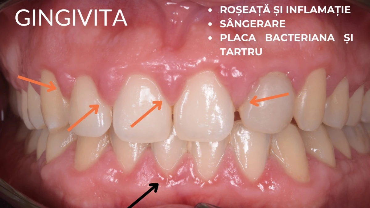 Gingivita. Boala parodontala. Simptome: sangerare gingivala, inflamare, umflaturi. Parodontolog timisoara.