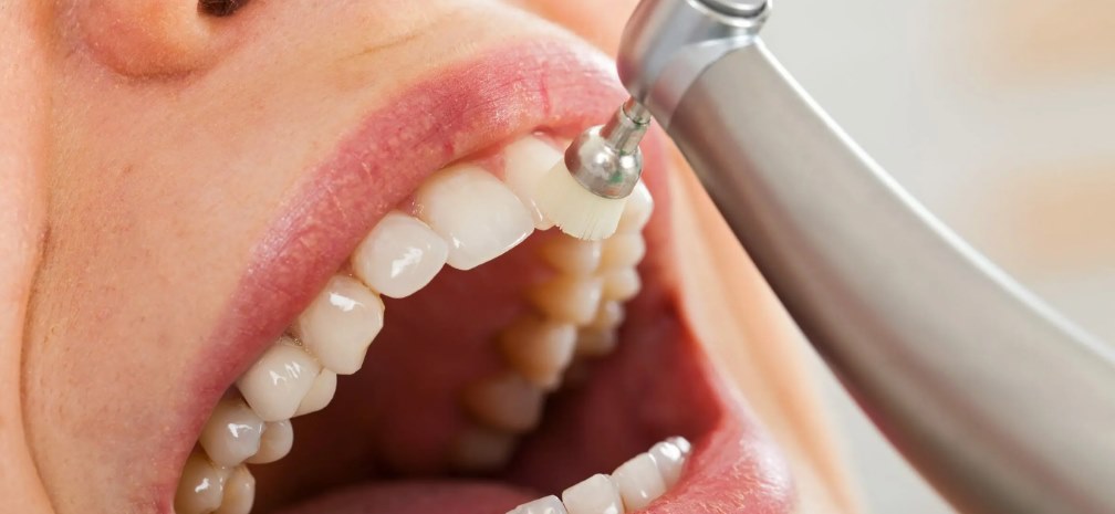 Airflow, detartraj si periaj profesional in Timisoara. Recomandarea unui medic dentist bun