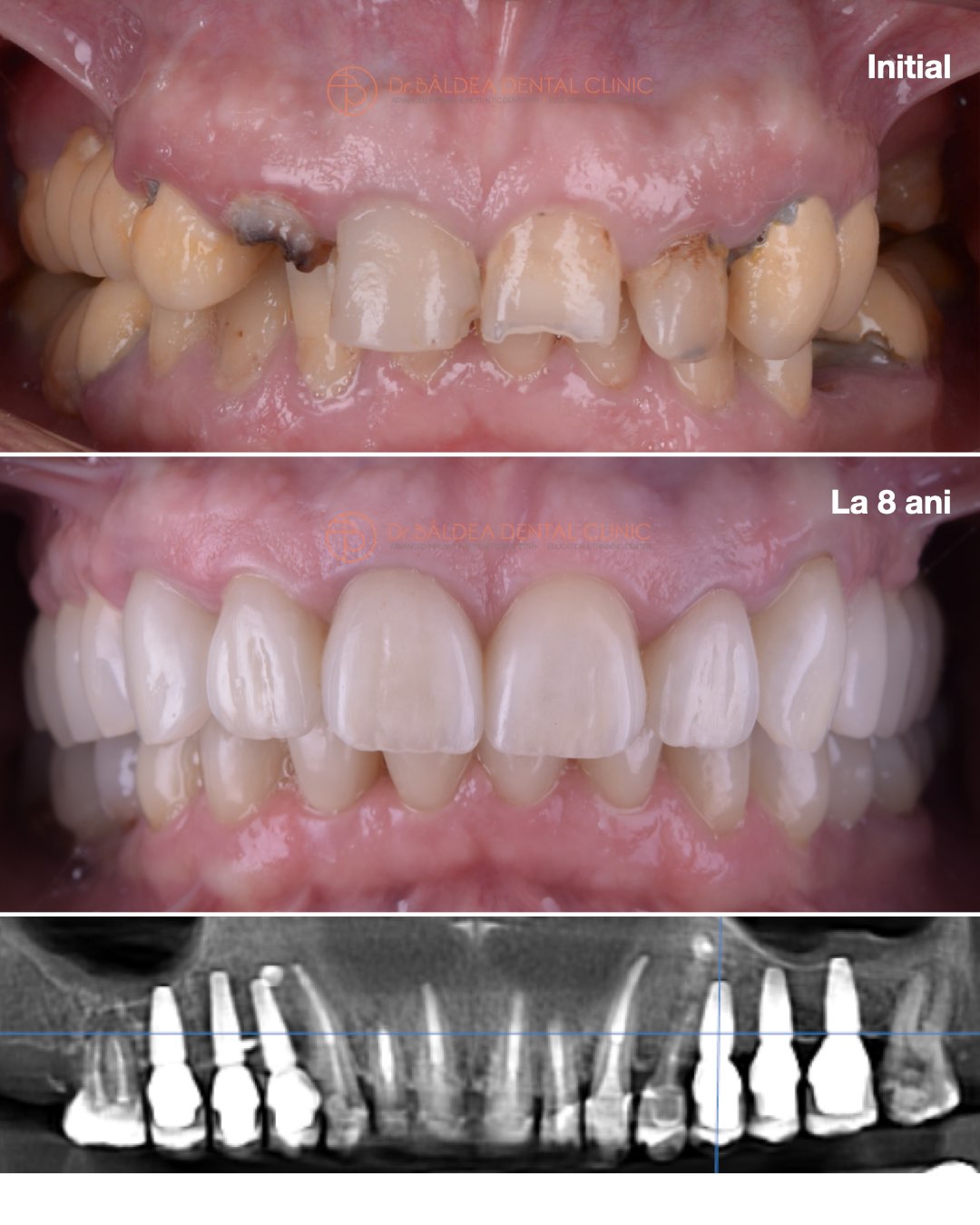Implantologie dentara cu reusita dupa 8 ani de la inserarea implanturilor dentare, la clinica stomatologica dr. Baldea Timisoara.