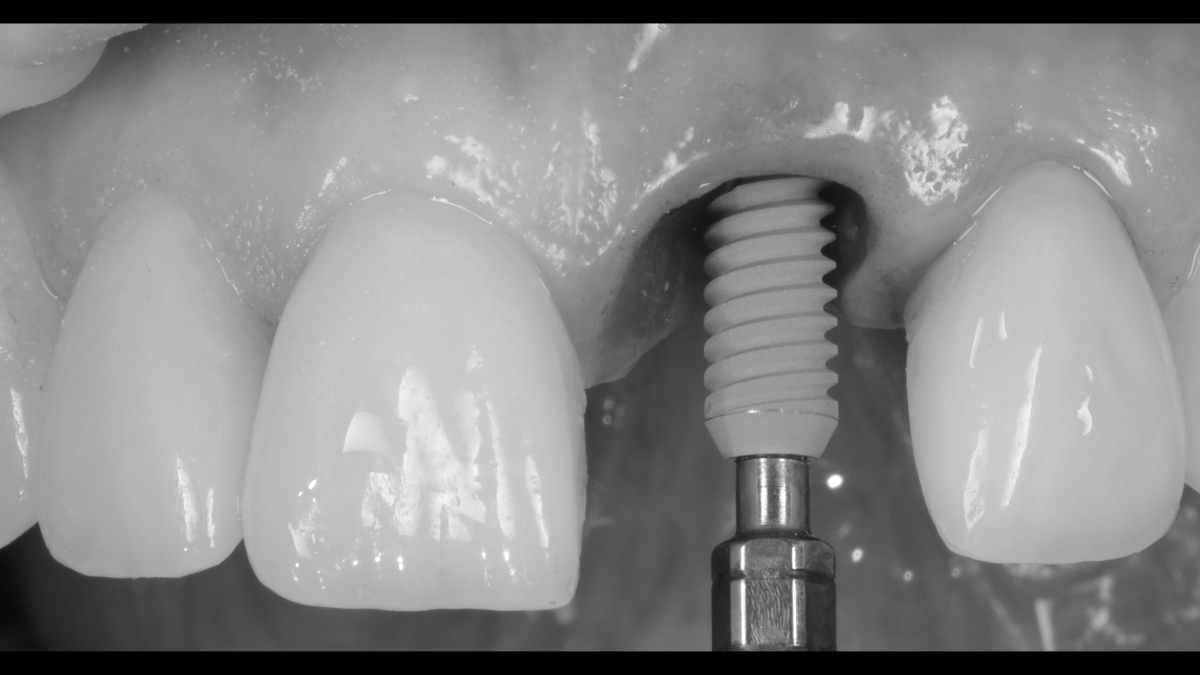 Inserarea unui implant dentar la clinica de implantologie dentara avansata dr. Baldea in Timisoara. 