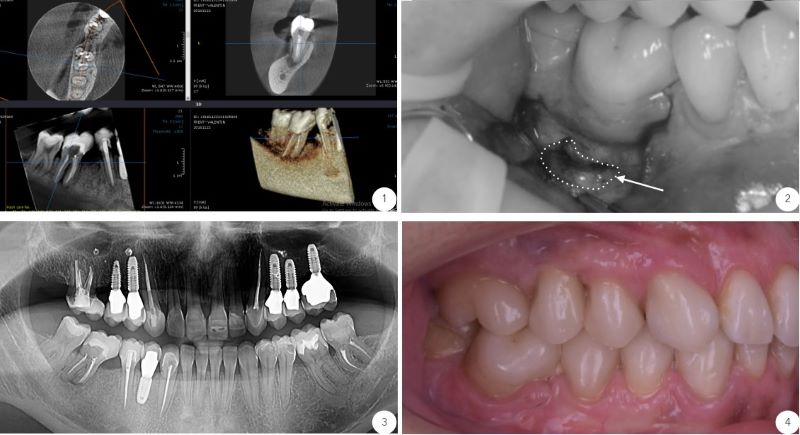 Micro-chirurgie endodontica. Departamentul de chirurgie dentara al clinicii stomatologice Dr. Baldea Timisoara.