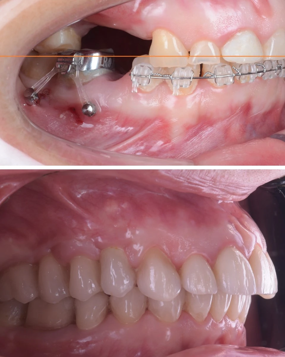 Rezultate obținute de medicul ortodont in tratamentul de intruzie ortodontica cu mini implant dentar. Clinica Dr. Baldea Timisoara.