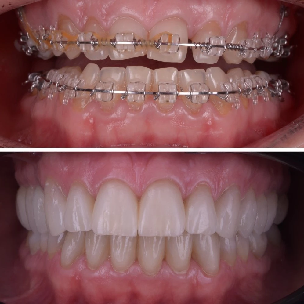 Aparat dentar in Timisoara. Rezultatele medicului ortodont specialist, cu aparatul dentar personalizat pentru fiecare pacient.
