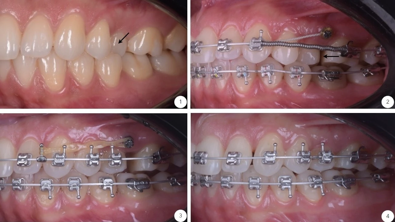 Medicul ortodont al clinicii dr. Baldea Timisoara a realizat tratament ortodontic distalizare si mezializare cu mini implant ortodontic.