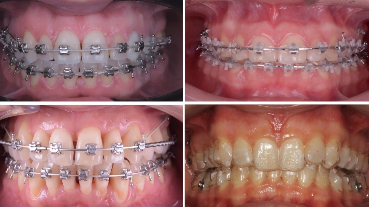 Tipul de aparat dentar recomandat de medicul ortodont al clinicii dr. Baldea Timisoara. Poate fi invisalign, aparat dentar fix ceramic, metalic sau aparat dentar invizibil.