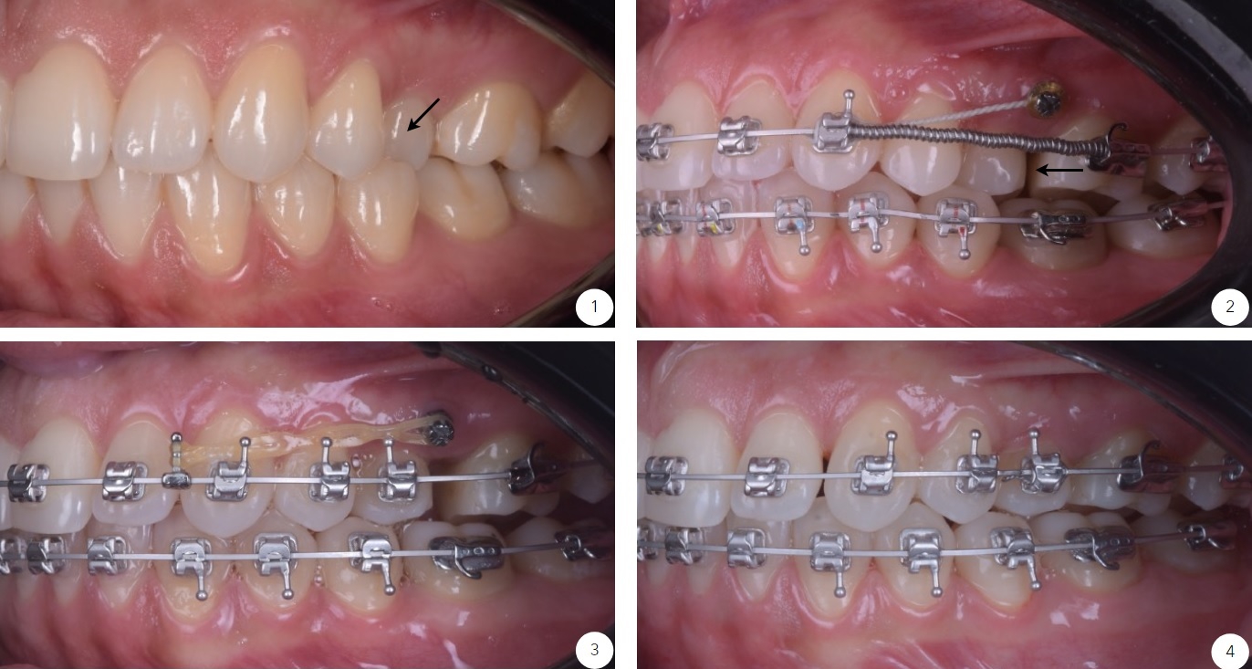 Tratament ortodontic alinierea dintilor cu mini-implant dentar. Distalizare, crearea de spatiu intre dinti.