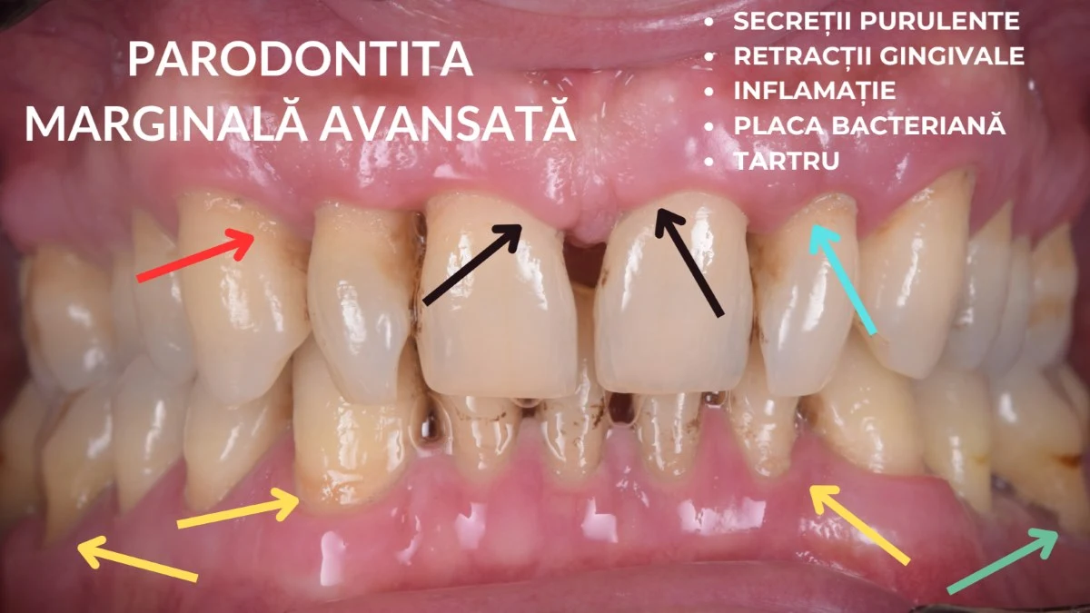 Parodontita avansata. Parodontoza. Consulta acum parodontologul Dr. Baldea Timisoara.