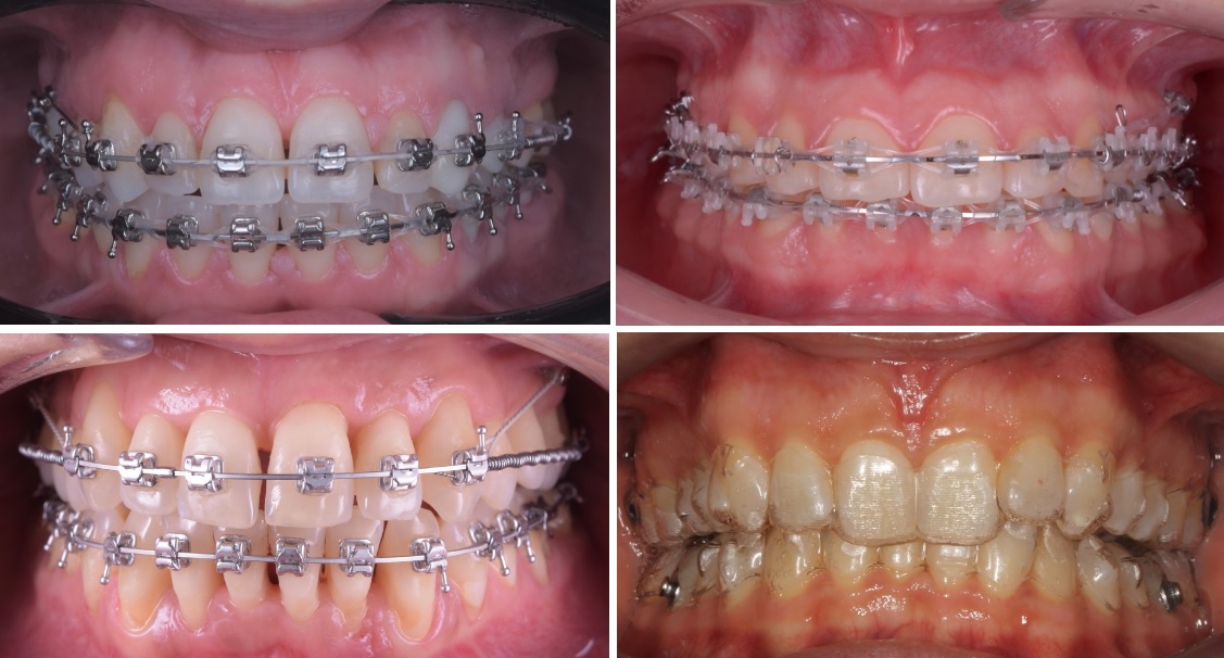 Tipuri de aparate dentare. Invisalign, aparat dentar fix ceramic sau rodiu si aparat dentar invizibil.
