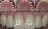 Reabilitare protetica si estetica pe implanturi dentare
