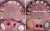 Reabilitare protetica si estetica pe implanturi dentare