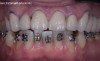 Reabilitare protetica si estetica pe implanturi dentare