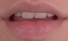 Fațete integral-ceramice cu preaparație dentară